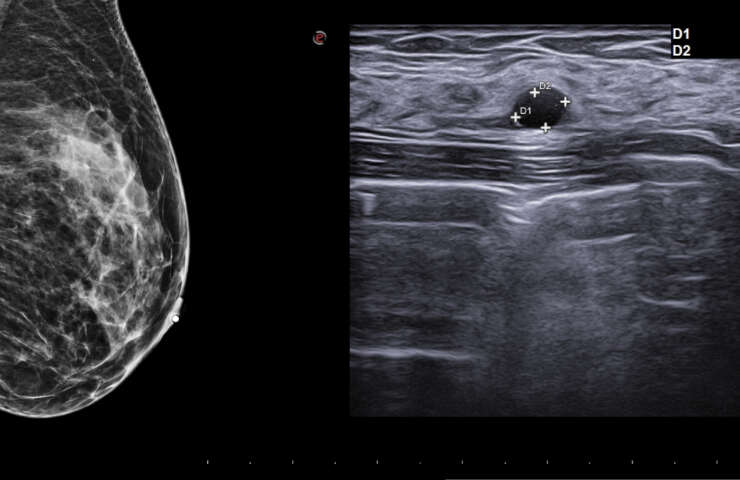 Mamografía y ecografía mamaria como estudios complementarios